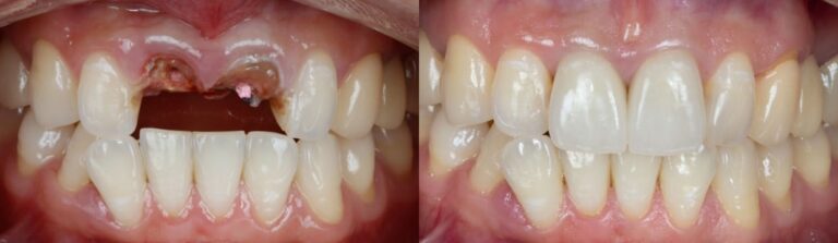 Before and after: Replacing two front crowns