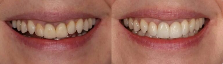 Before and after: Rebuilding teeth with crowns