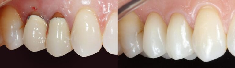 Before and after: Zirconia Crown