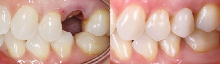 Before and after: Zirconia Crown