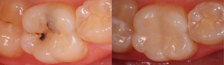 Before and after: Removing decay/caries on posterior tooth