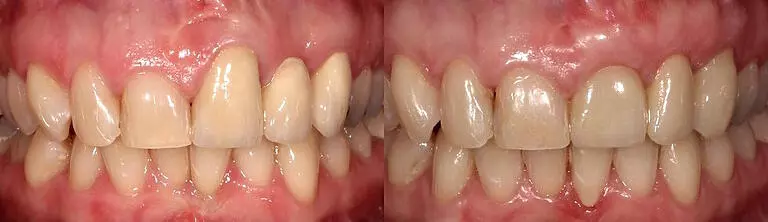 Before and after: Aesthetic Dental Bridge