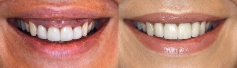 Before and after: Immediate Implants