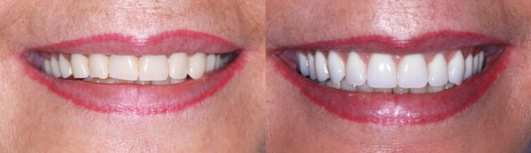 Before and after: Dentures