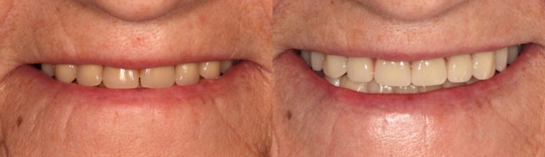 Before and after: Dentures