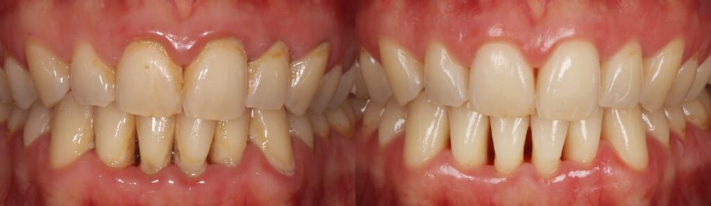 Dh Before After