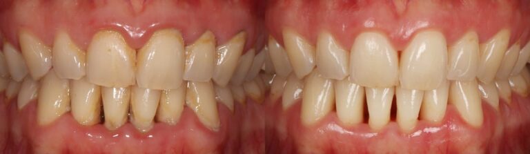 Before and after: Dental Hygiene Deep Clean