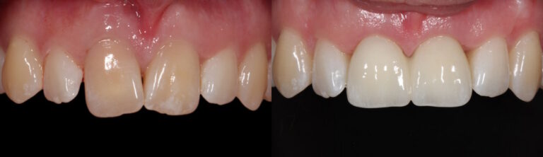 Before and after: Immediate implant with bone augmentation and gum graft
