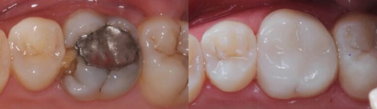 Before and after: Composite filling to replace decayed tooth