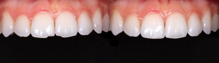 Before and after: Edge repair with composite bonding