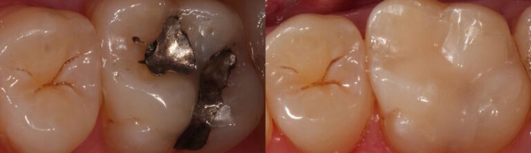 Before and after: Fillings