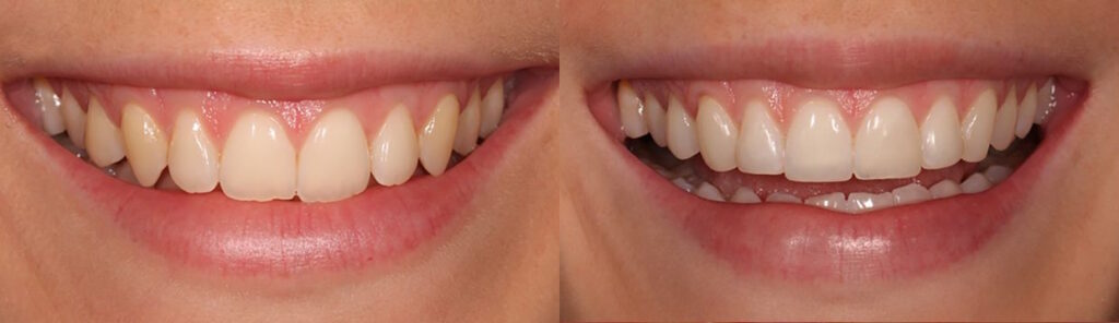 Before and after: Edge composite bonding