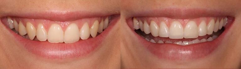 Before and after: Edge composite bonding