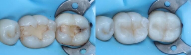 Before and after: Replacing failed fillings