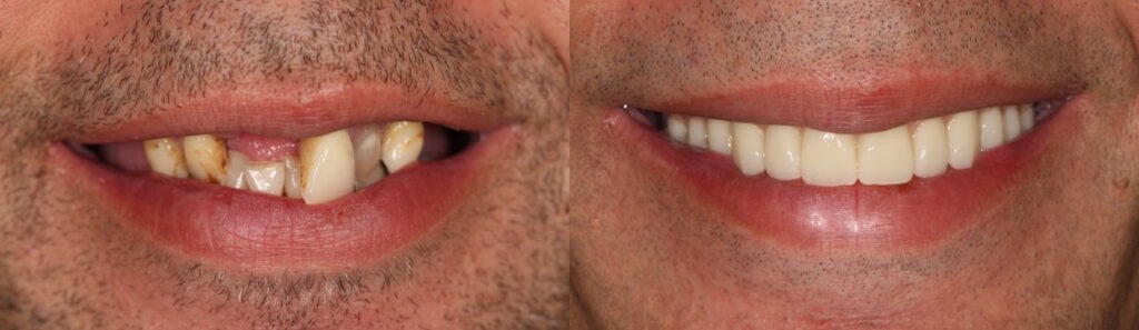 Before and after: Fixed-teeth-in-a-day/All-on-4