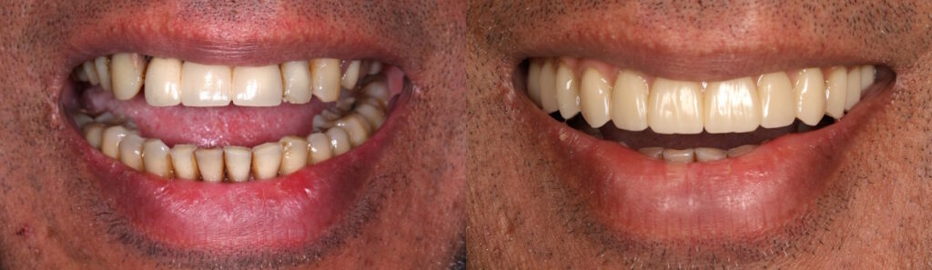 Before and after: Fixed-teeth-in-a-day/All-on-4