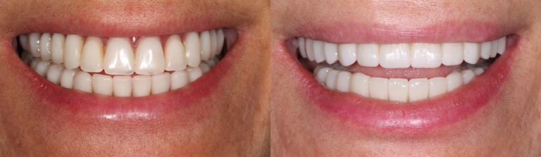 Before and after: All-on-4 Dental Implants