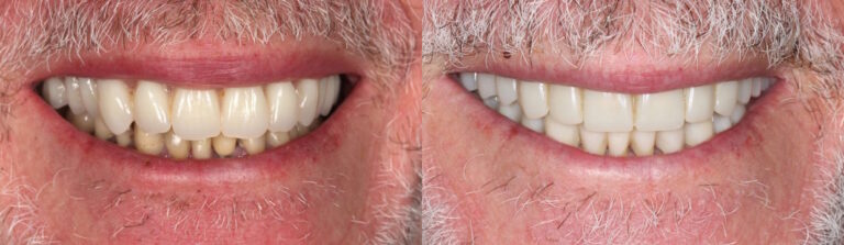 Before and after: Fixed teeth in a day