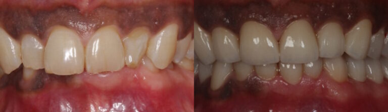 Before and after: Full mouth rehabilitation with bite correction