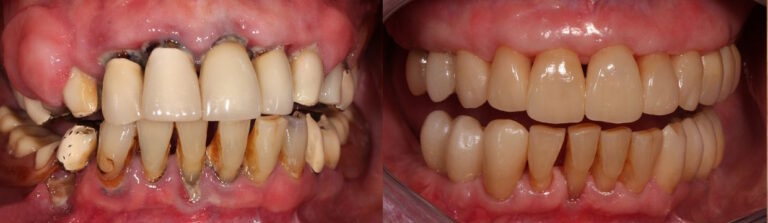 Before and after: Full mouth reconstruction