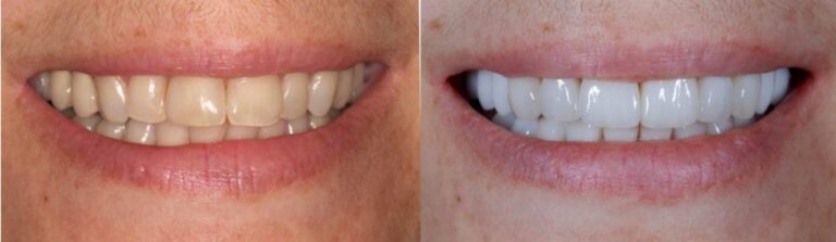 Before and after: Full Mouth Reconstruction