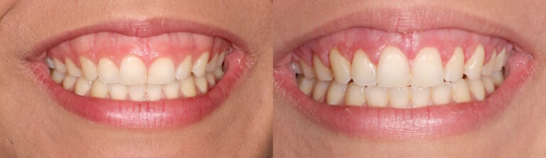 Before and after: Correction of a gummy smile