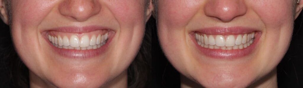 Before and after: Gummy Smile Treatment