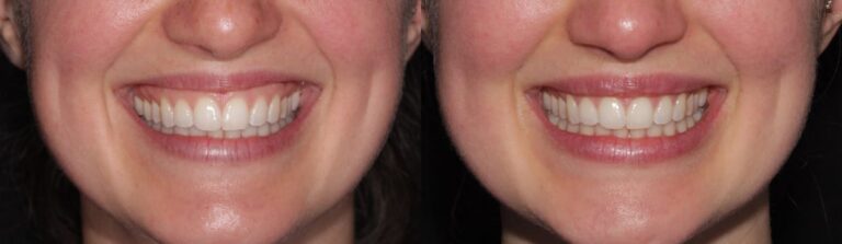 Before and after: Gummy Smile Treatment