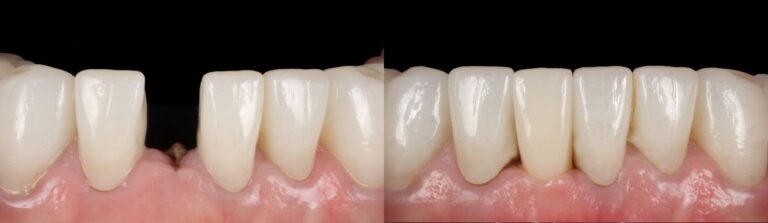 Before and after: Immediate implants for a broken front tooth