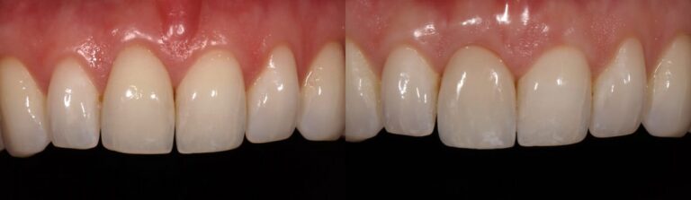 Before and after: A step-by-step approach to immediate implants