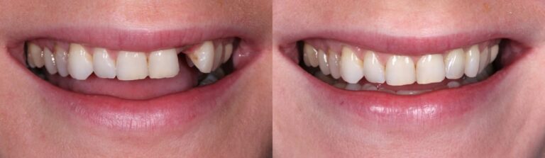 Before and after: Single implant on a front tooth