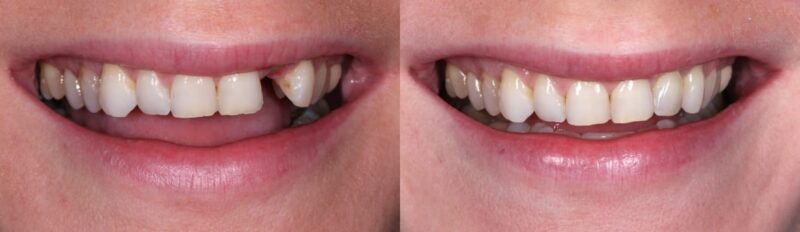 Single implant on a front tooth before and after
