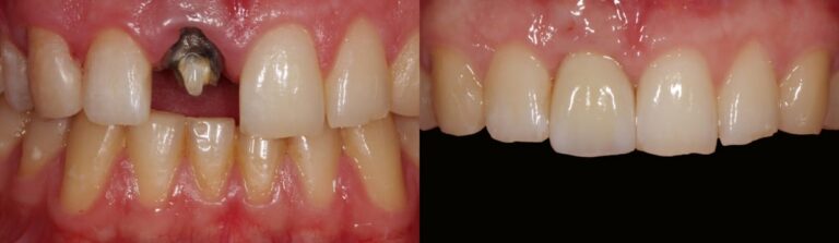 Before and after: Implant on a central incisor
