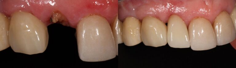 Before and after: Implant Crown