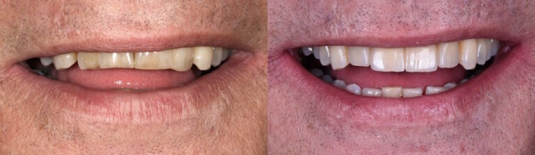 Before and after: Implants and dental bridge