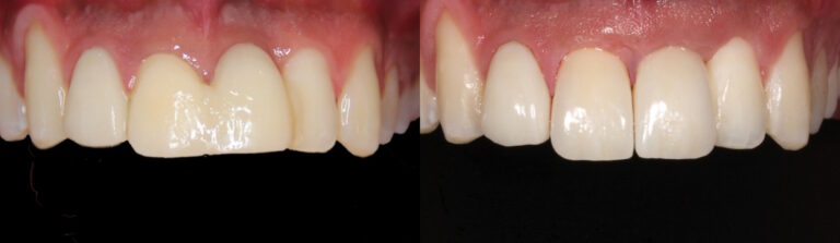 Before and after: Implant and crowns to replace failing front teeth