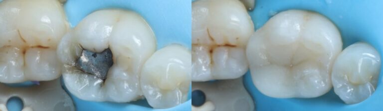 Before and after: Organic Inlays