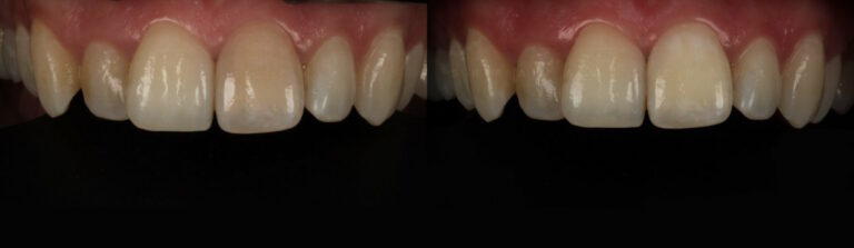 Before and after: Internal Teeth Whitening