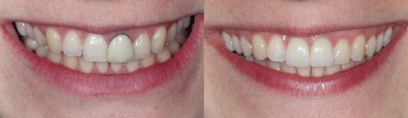 Internal Teeth Whitening before and after