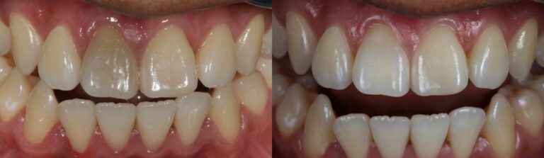 Before and after: Internal Teeth Whitening