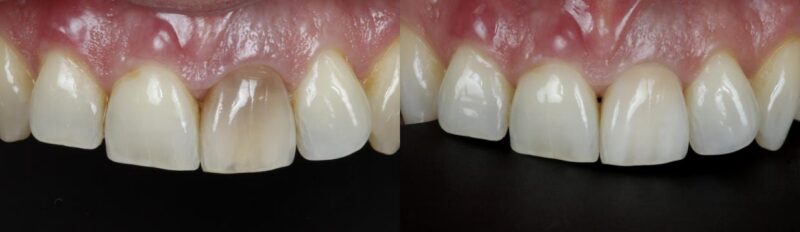Internal Teeth Whitening before and after