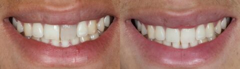 Internal Teeth Whitening