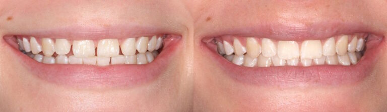 Before and after: Invisalign