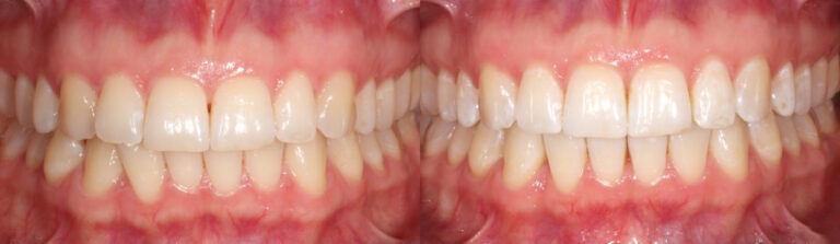 Before and after: Invisalign