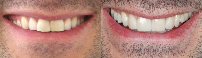 Before and after: Invisalign and Veneers