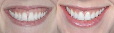 Invisalign