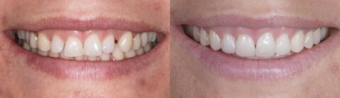 Invisalign & Composite Bondings