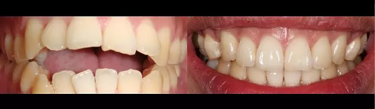 Lingual Braces 1 768x223.jpg