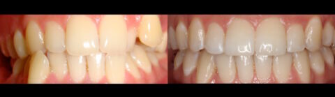 Lingual Hidden Braces