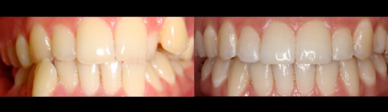 Before and after: Lingual Hidden Braces